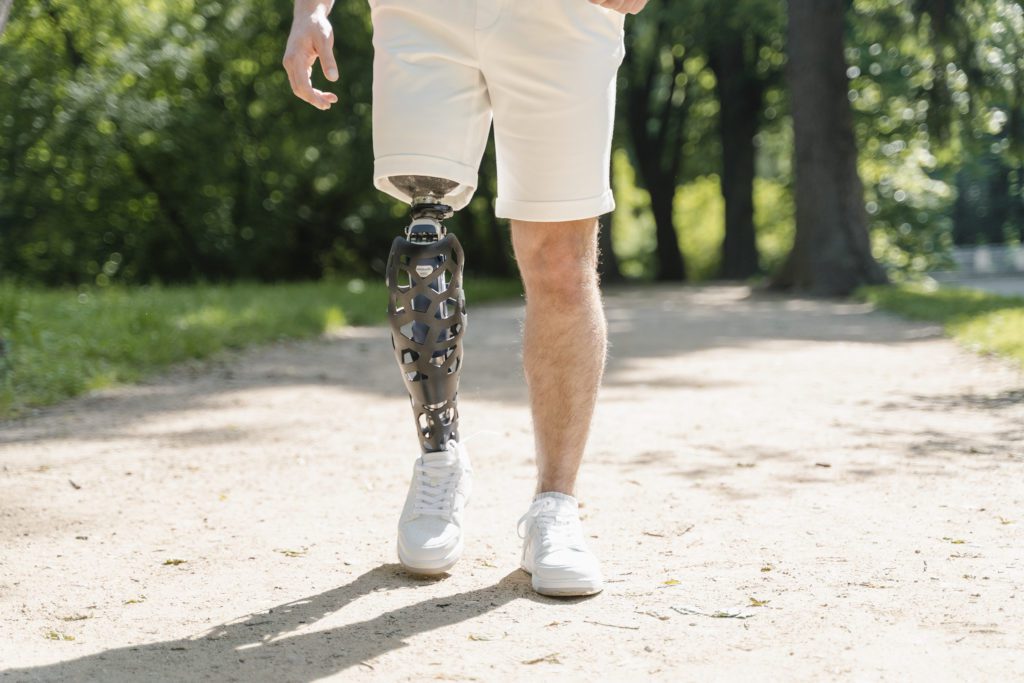 Amputazione gambe: una protesi aiuta a camminare normalmente